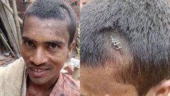सिर पर टांके की जगह स्टेपलर पिन! बिहार की इस घटना ने सबको चौंका दिया